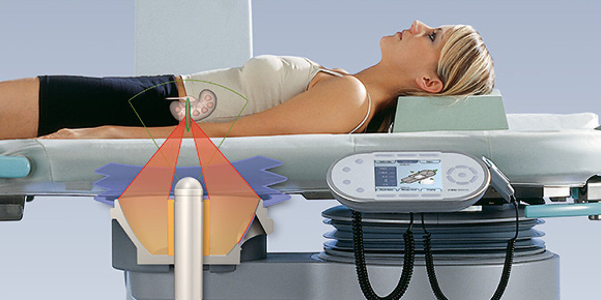 Kidney Stone Removal And Biliary Calculi Can Be Treated Non-Invasively With Extracorporeal Shock Wave Lithotripsy