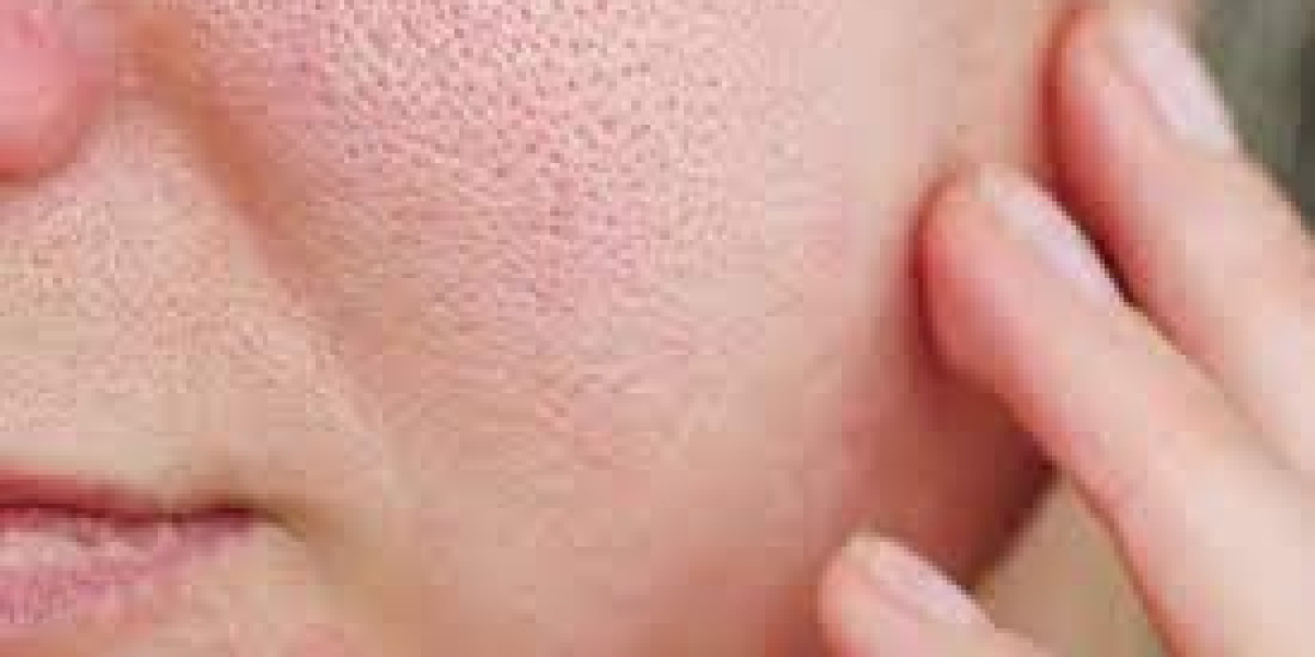 Achieve Flawless Skin with Pore Treatment in Singapore