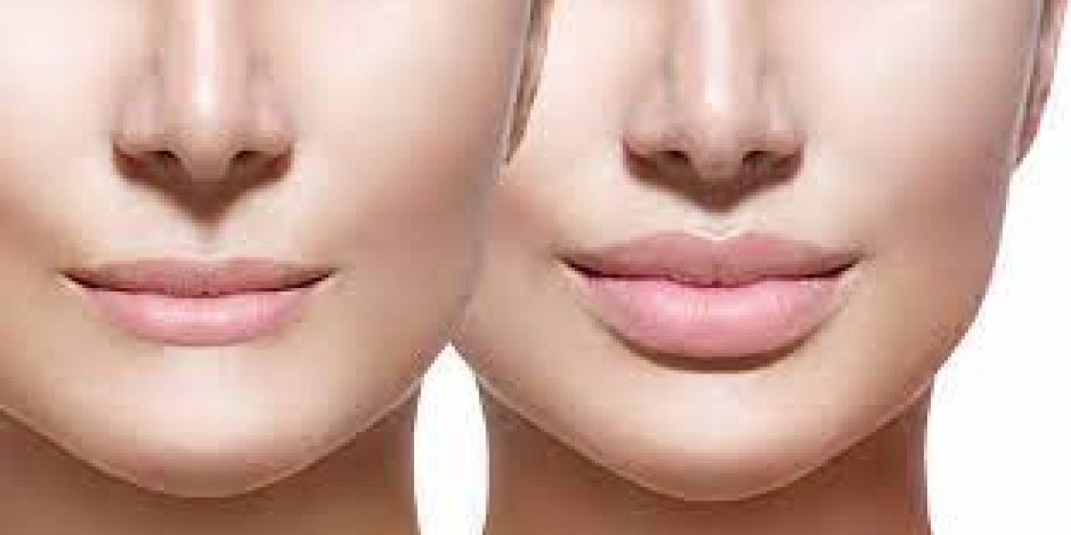 Why have lip fillers become so popular?