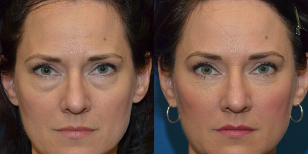 Reclaiming Youthful Radiance: Embarking on the Eye Bag Removal Journey