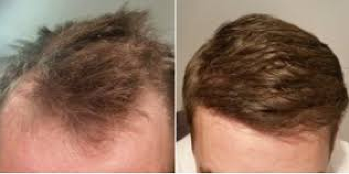 The Latest Hair Transplant Trends