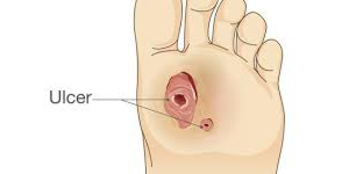 2023 Diabetic Foot Ulcers Market | Report By 2033