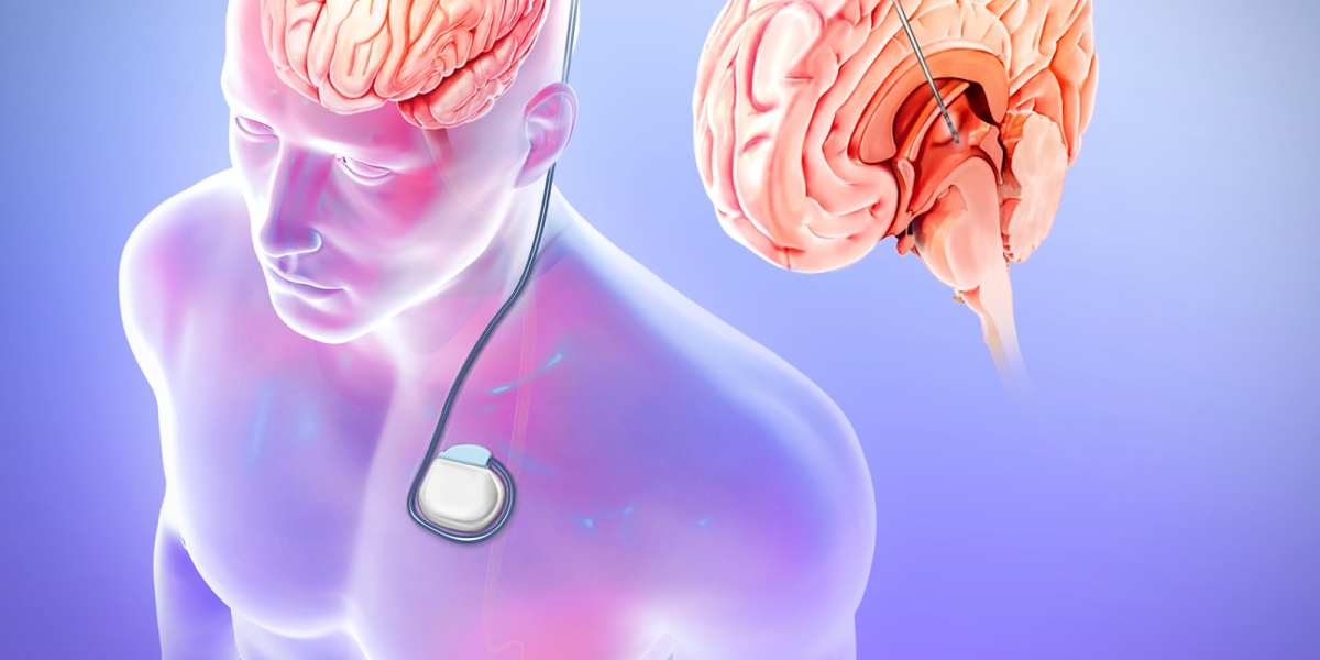 Global Epilepsy Surgery Market Share Thriving Accruals; Confirms MRFR