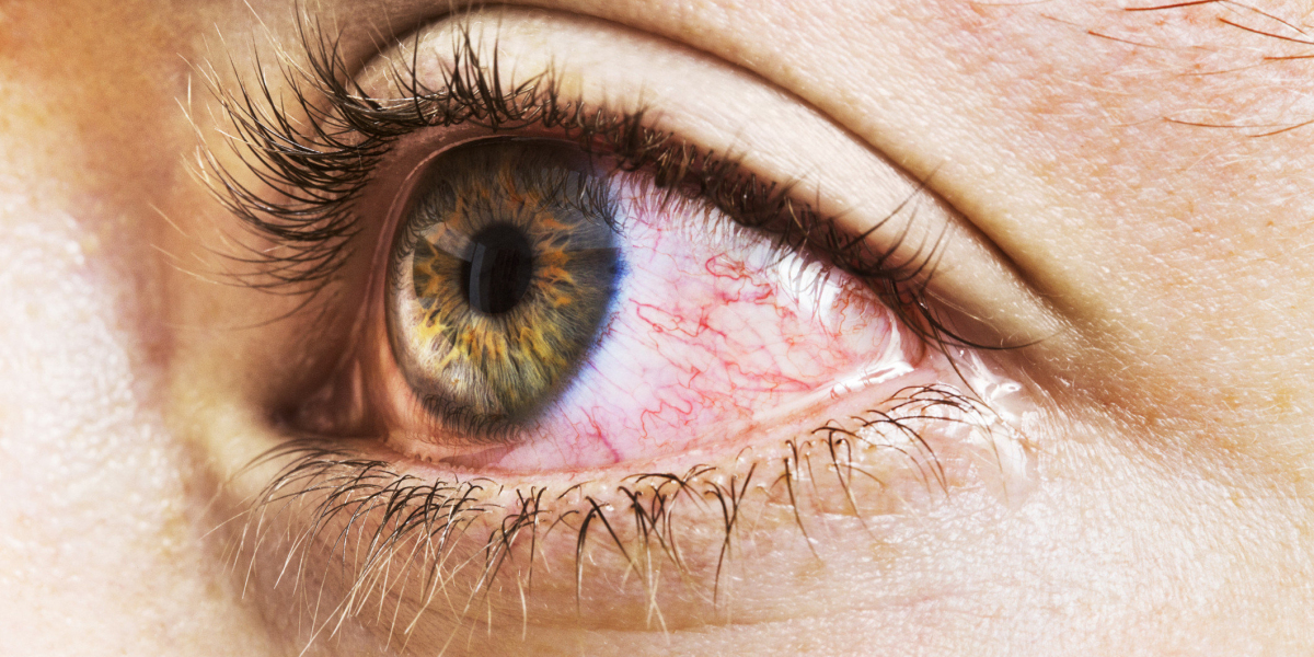 Rising Blepharitis cases to boost the Blepharitis Treatment Market Growth