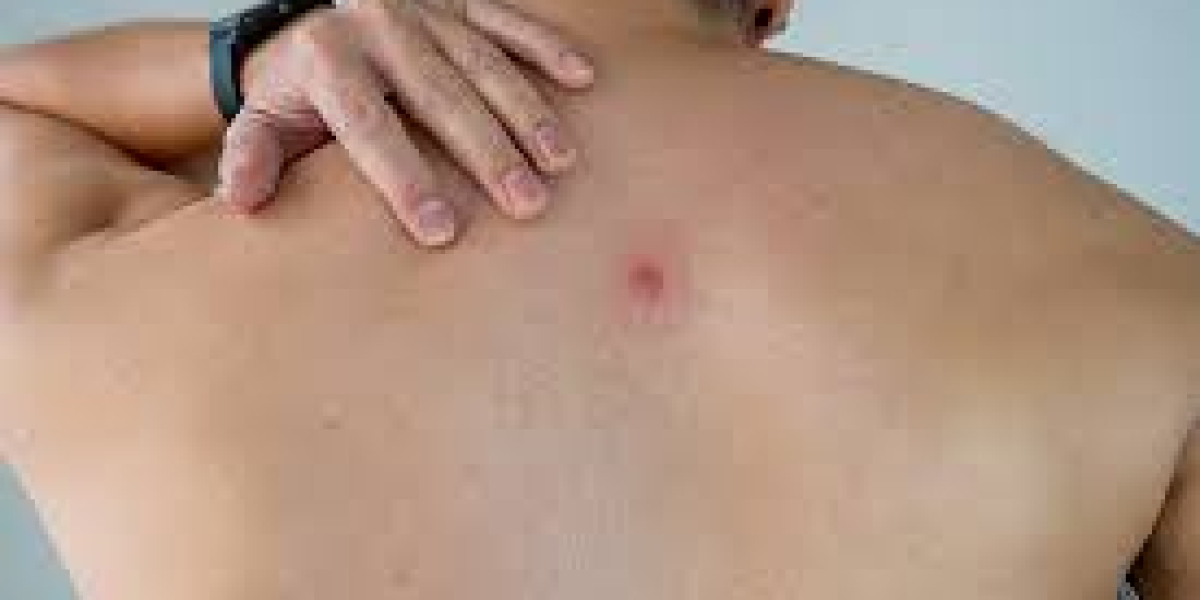 2023, Abscess Market | Industry Analysis Till 2033