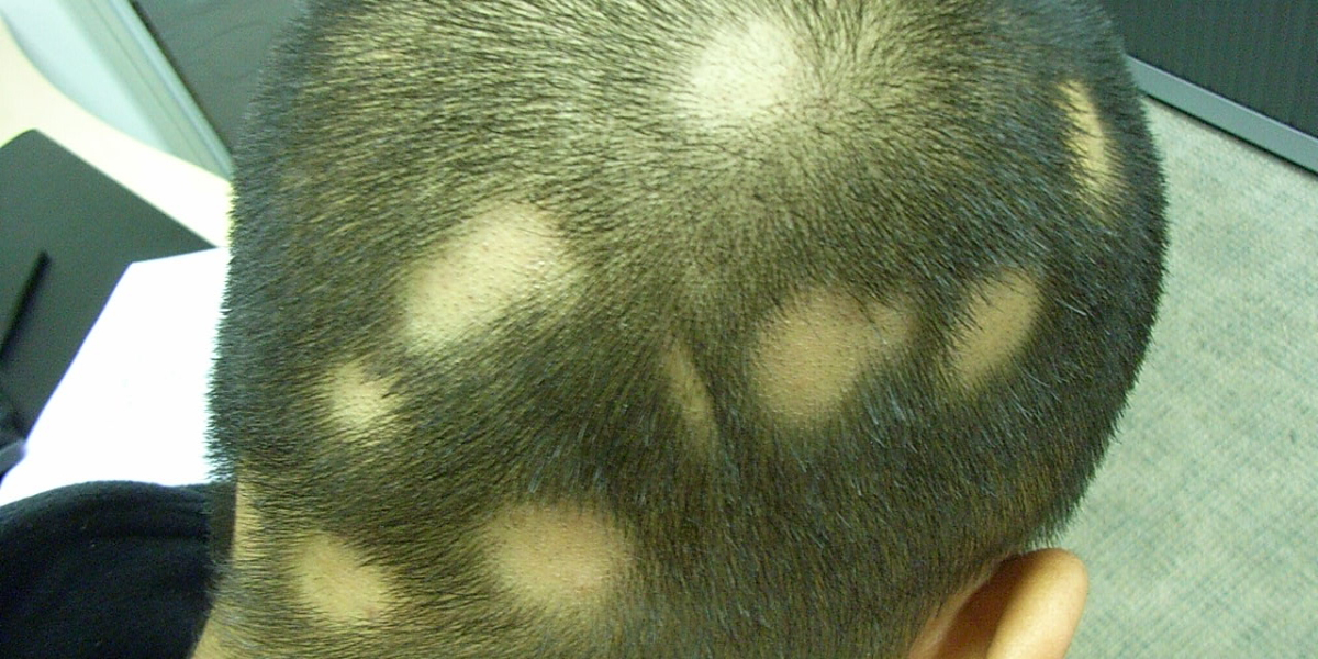 Is Hair Transplant an Option For Traction Alopecia?