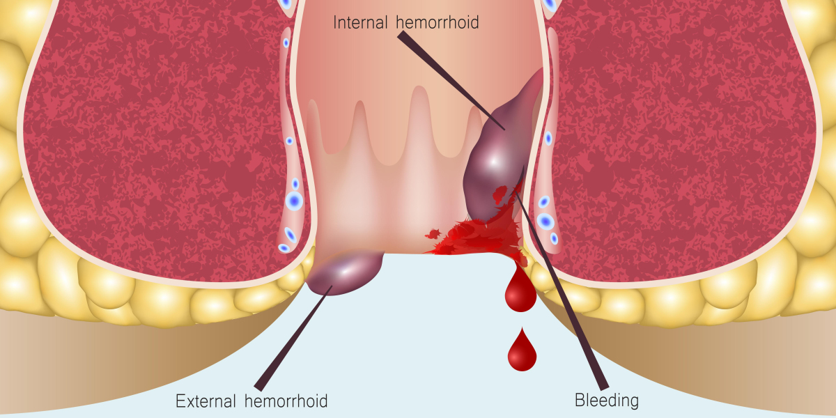 Global Hemorrhoids Treatment Market Share with Regional Competition Facts and Figures