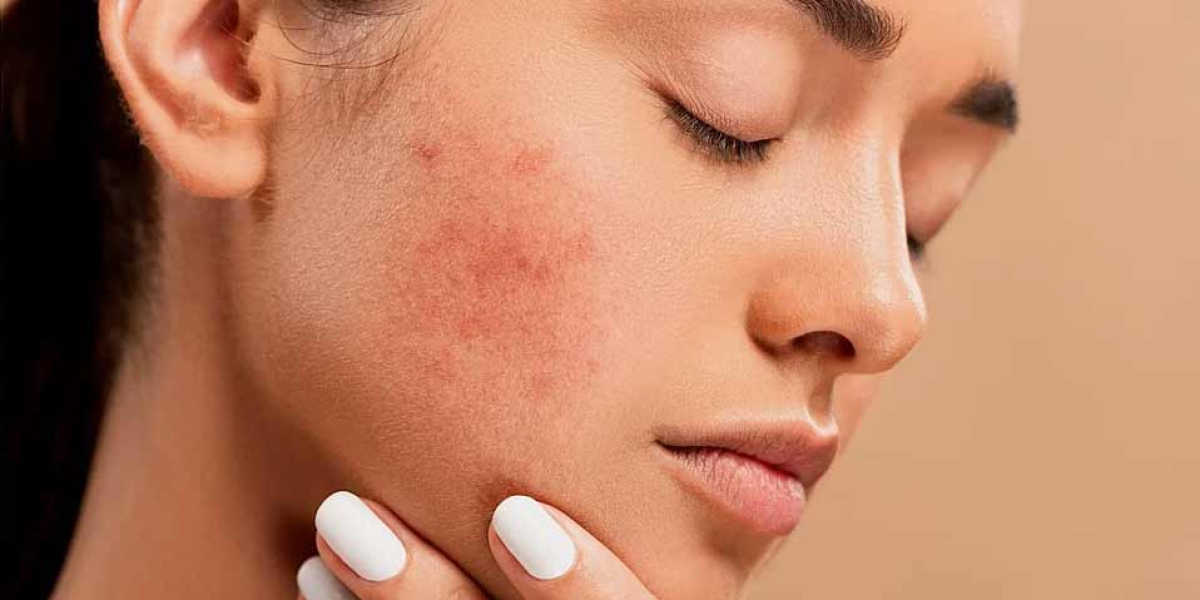 Navigating the Journey: Your Guide to Effective Acne Scar Removal