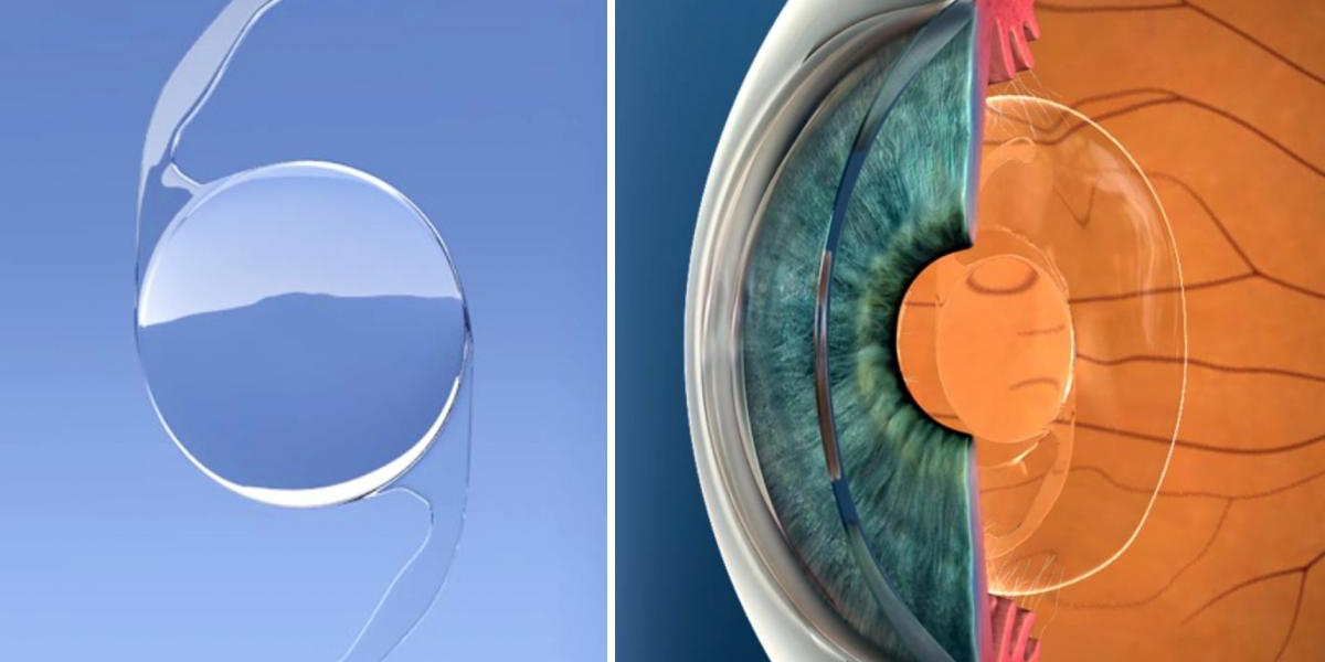 Intraocular Lens Market Share to Cross USD 5.2 Billion Valuation by 2030