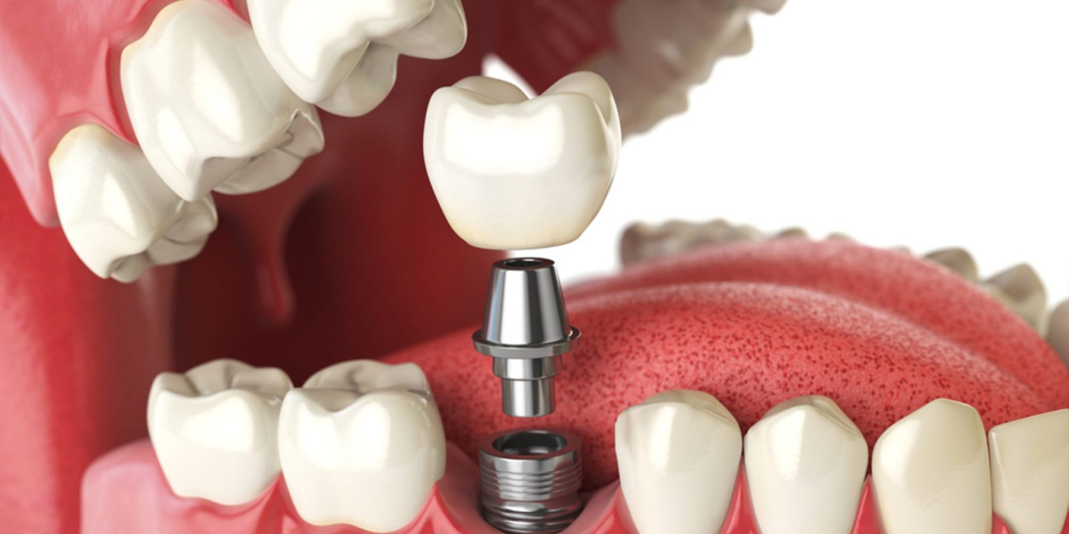 Canada Dental Implants Market: Forecasted Trends and Competition from 2018-2028