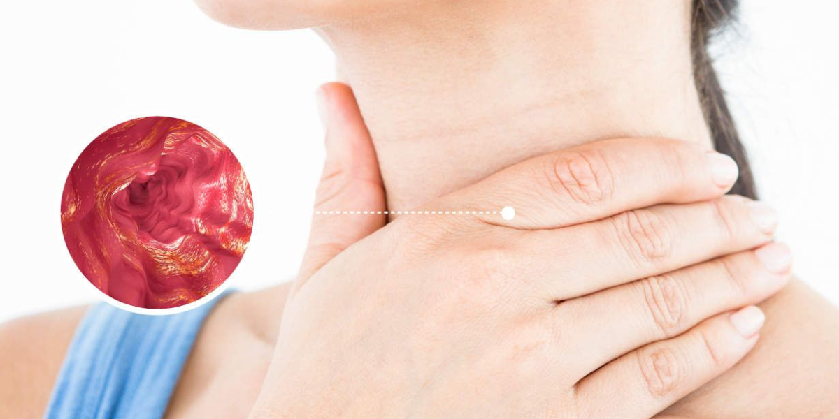 The Evolving Landscape of the Eosinophilic Esophagitis Market   