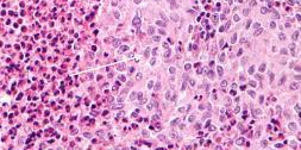 Langerhans Cell Histiocytosis Market Size, Growth, Overview & Trends 2023-2033