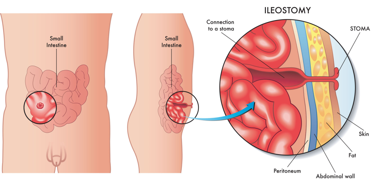 Ileostomy Market - Trending Strategies and Application Forecasts by 2030