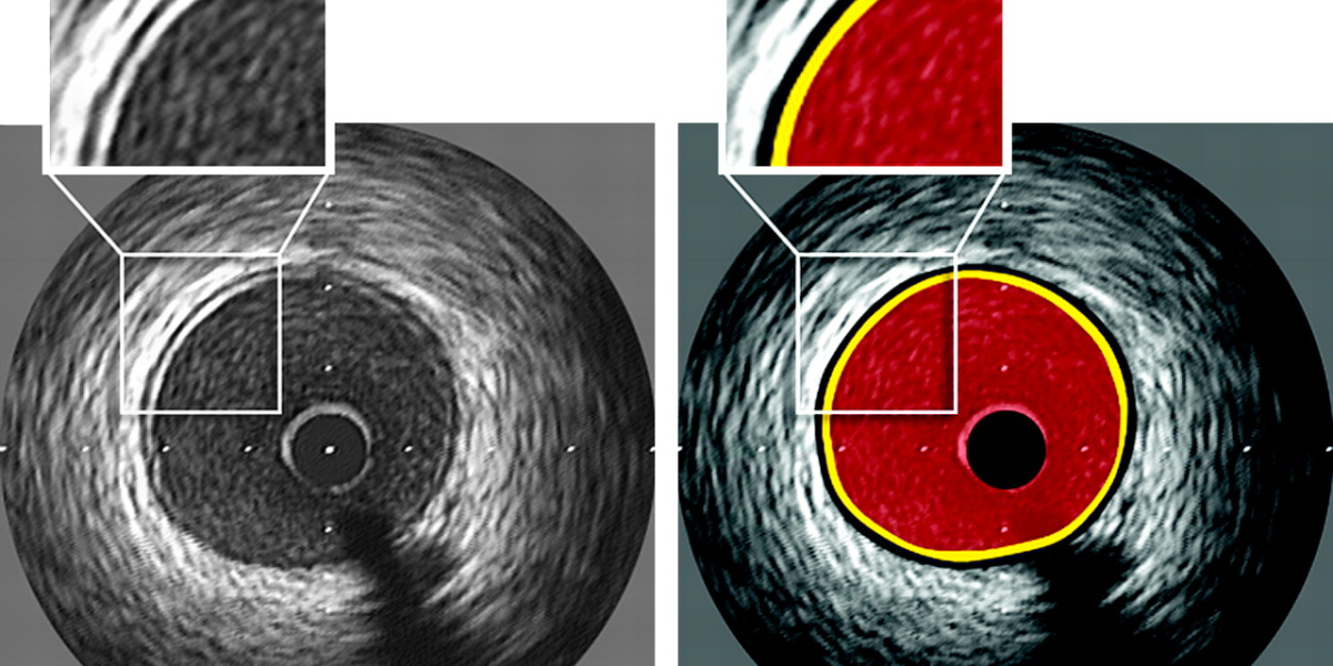 Intravascular Ultrasound Market - Segment and Industry Growth by Forecast to 2030