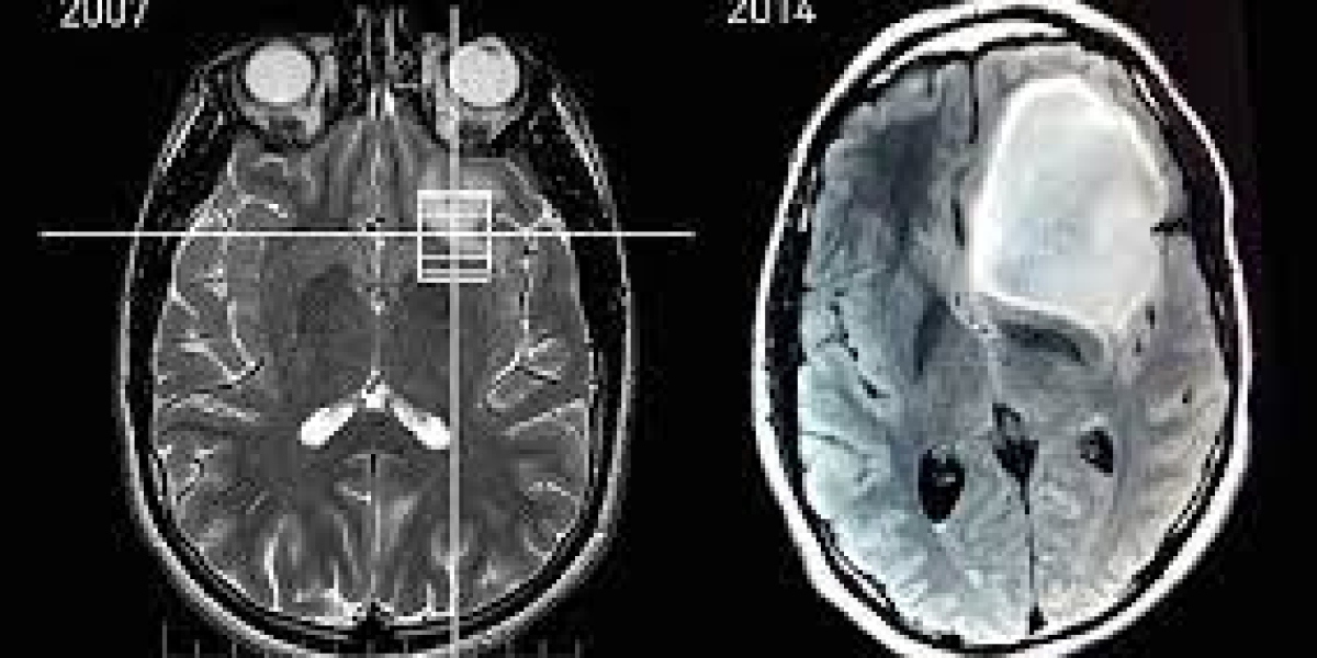 Astrocytoma Market Size, Growth, Overview & Forecast 2023-2033