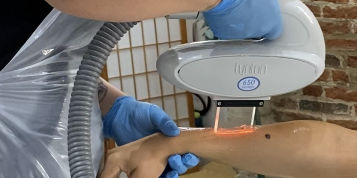 IPL Hair Removal London