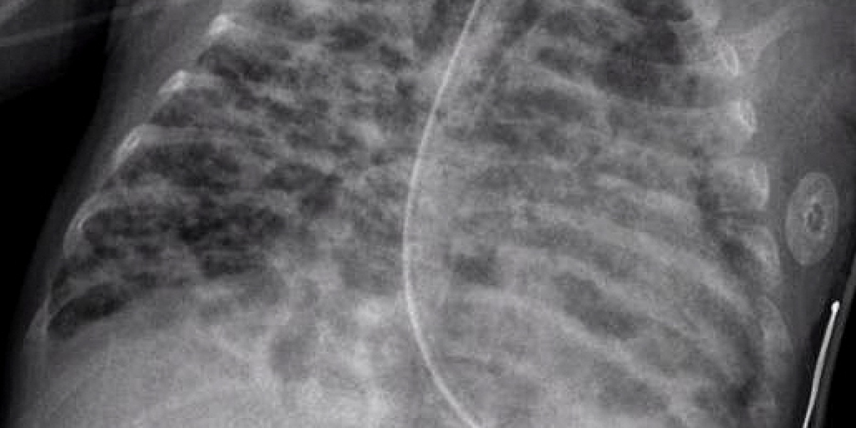 2023, Bronchopulmonary Dysplasia Market Research Report Analysis by 2033