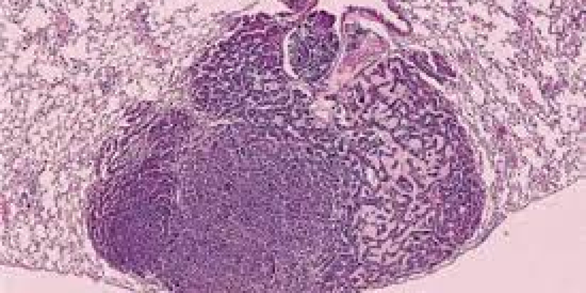 Adenoma Market Share, Overview and Industry Trends 2023-2033