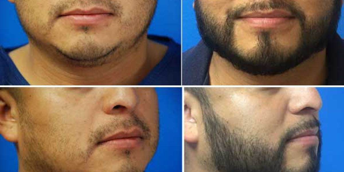 How to do After Care After Facial Hair Transplant?