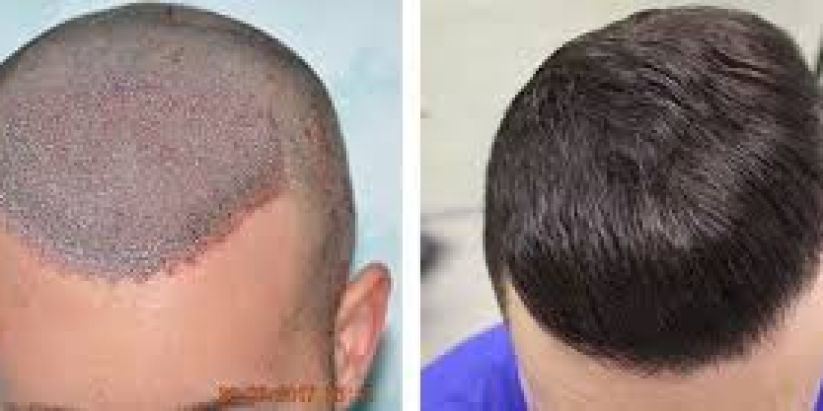 Why Surgeons Preferers FUE Hair Transplant?