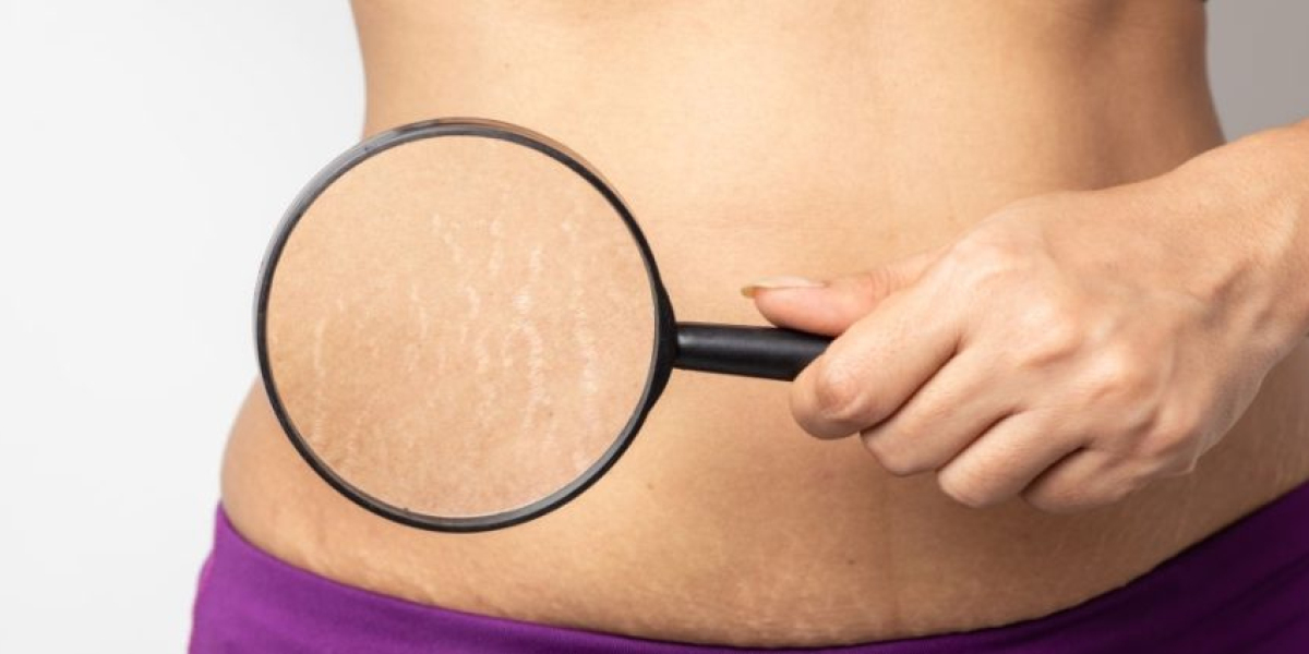 Global Cellulite Treatment Market Is Estimated To Witness High Growth Owing To Rising Prevalence of Obesity and Increasi