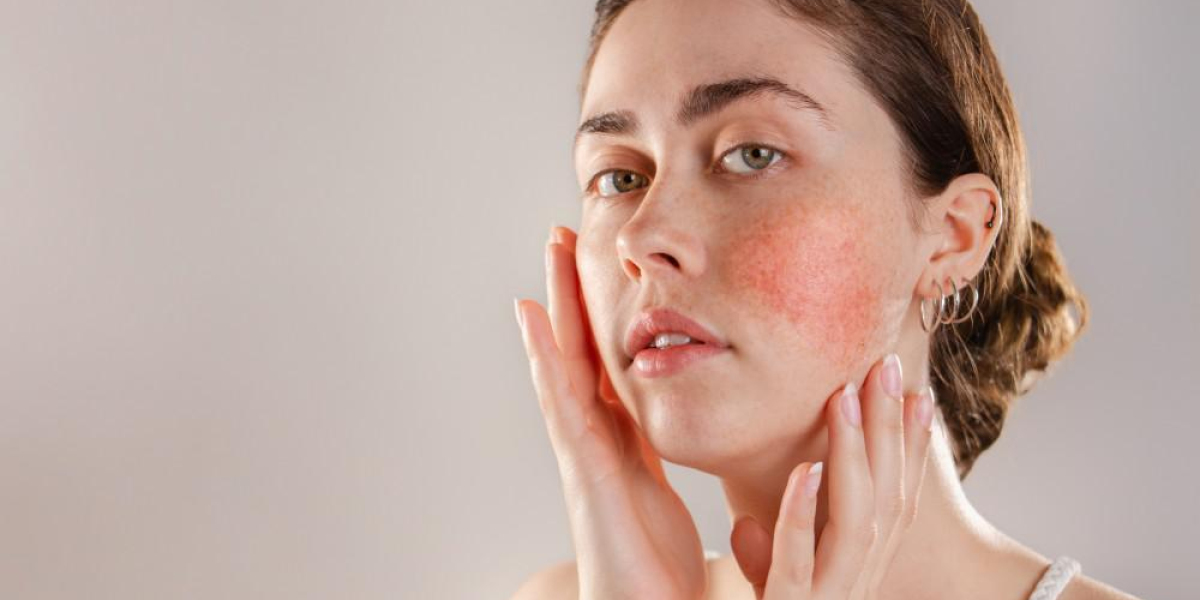 Papulopustular Rosacea Market Size, Growth, Opportunity and Forecasts to 2033