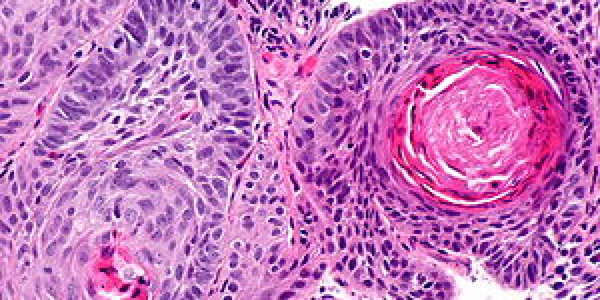 2023, Esophageal Squamous Cell Carcinoma Market | Industry Analysis Till 2033