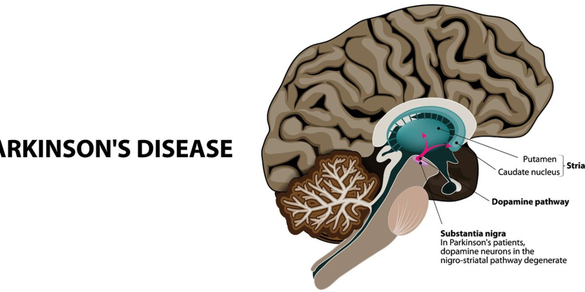 The Parkinson's Disease Puzzle: From Detection to Market Opportunities