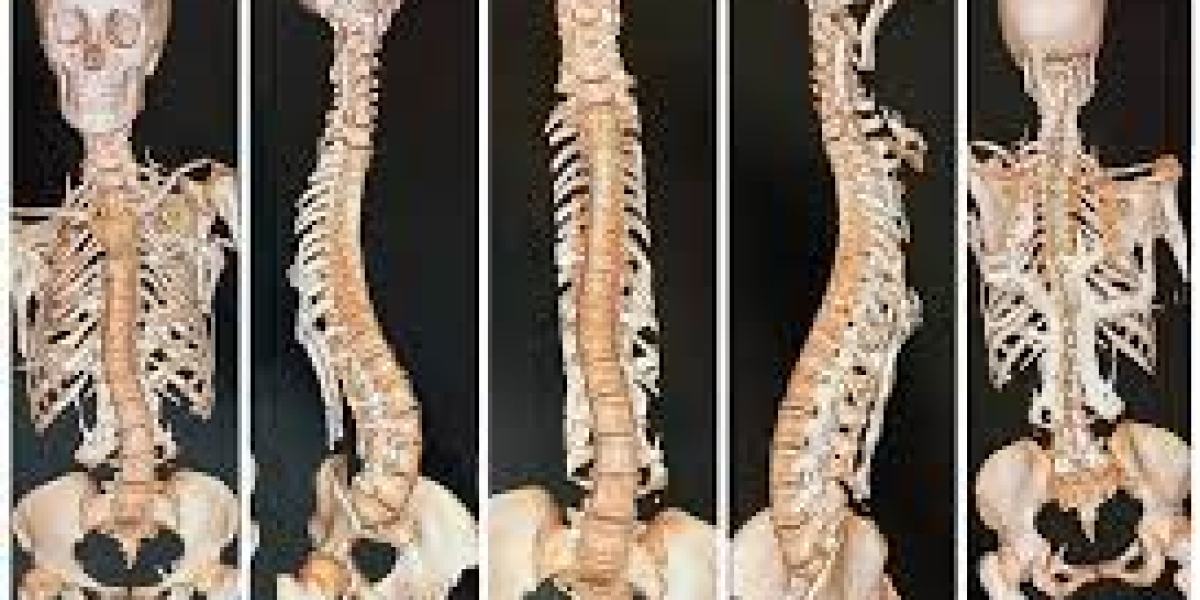 fibrodysplasia ossificans progressiva market Analysis, Overview and Forecast 2023-2033