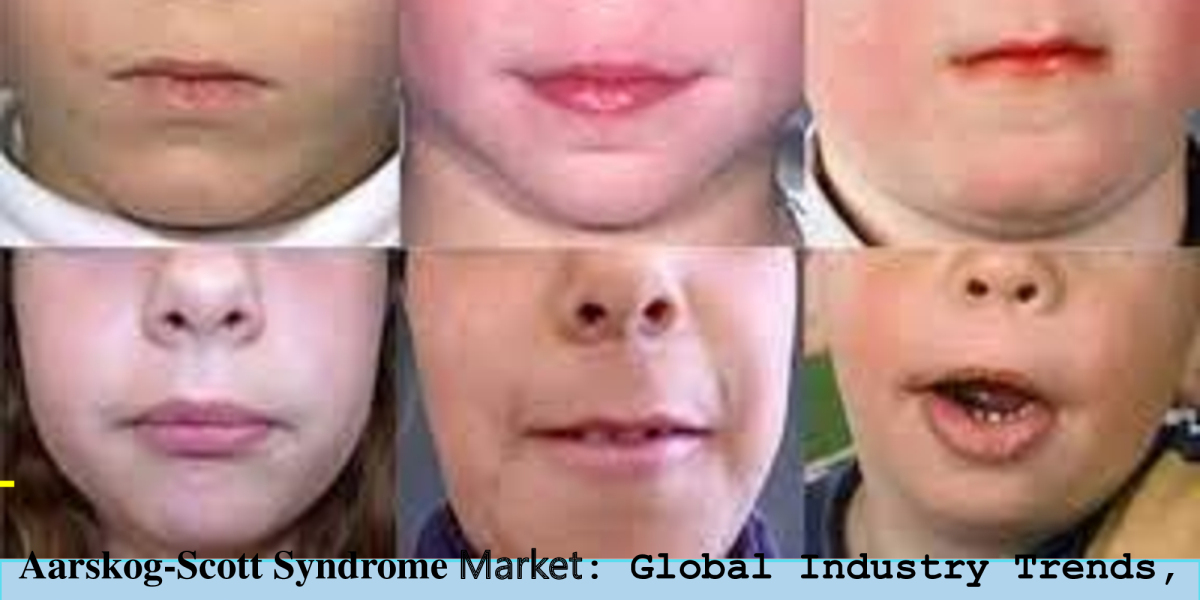 2023, Aarskog-Scott Syndrome Market | Industry Analysis Till 2033