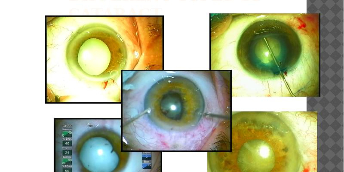Shaping the Future of Vision: Exploring the Phacoemulsification System Market