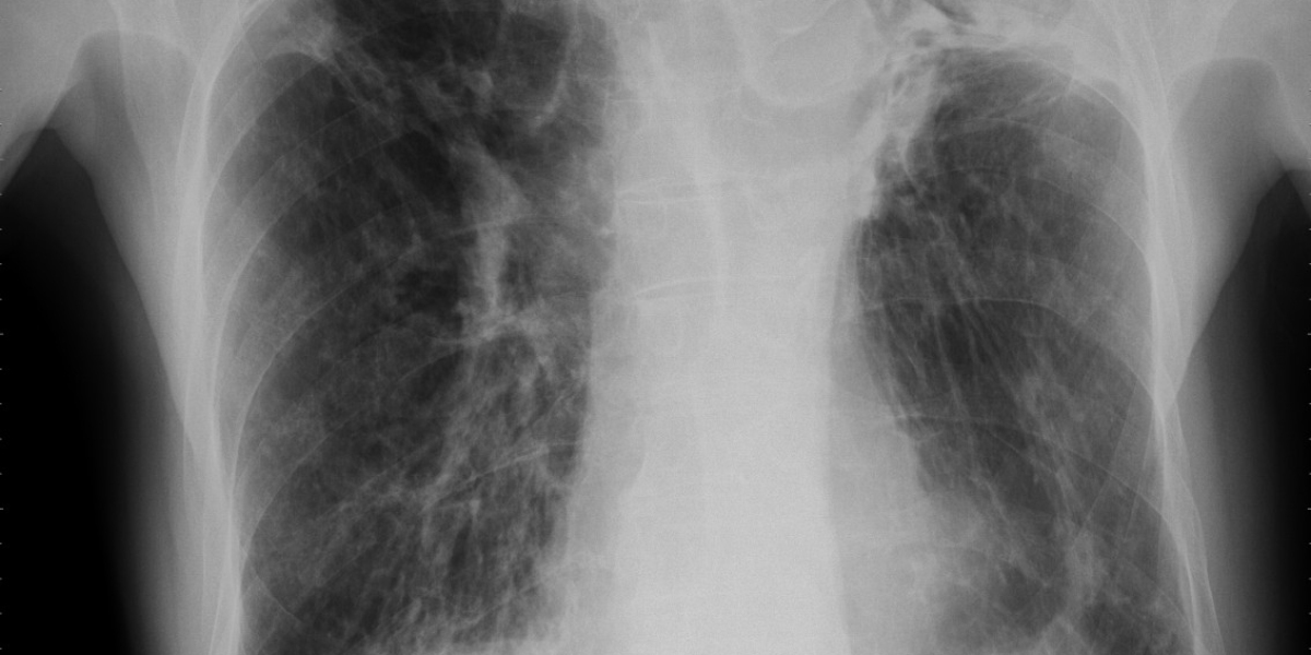 Fungal Lung Diseases Market Size, Epidemiology and Forecast 2023-2033