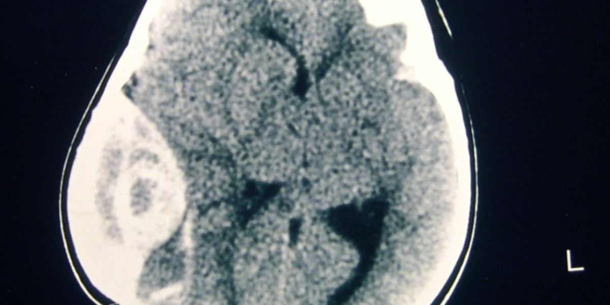 2023, Craniocerebral Trauma Market Research Report Analysis by 2033