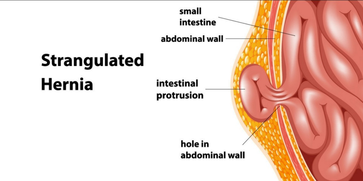 Dr. Tarun Mittal - Best Hernia Doctor in Delhi
