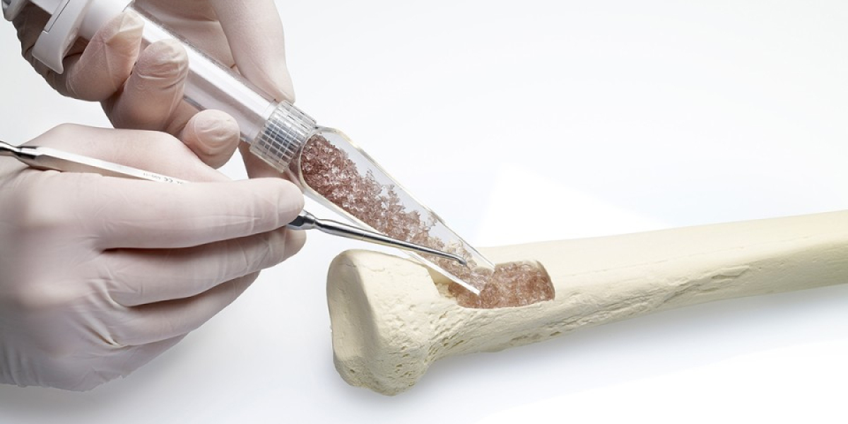 Bone Graft and Substitutes Market Research Report 2023-2028, Industry Growth, Share, Size and Forecast