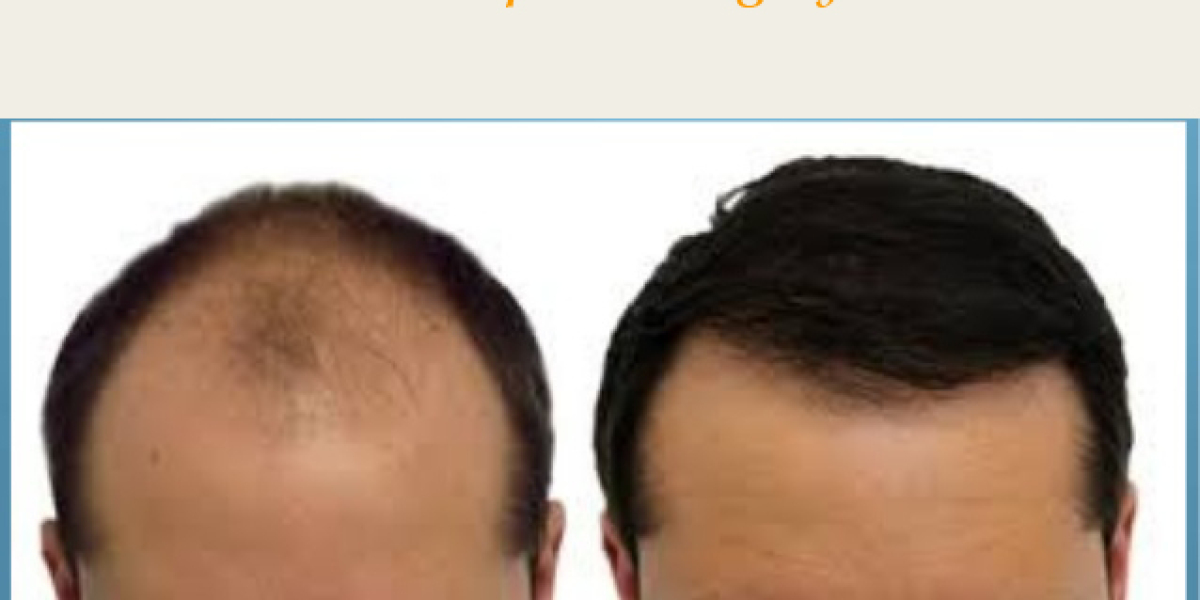 How To Determine Per Graft Cost for Hair Transplantation?