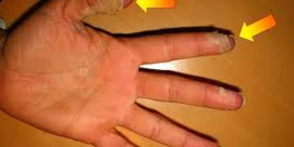 Kawasaki Disease Market Analysis, Overview, Trends and Forecast 2023-2033