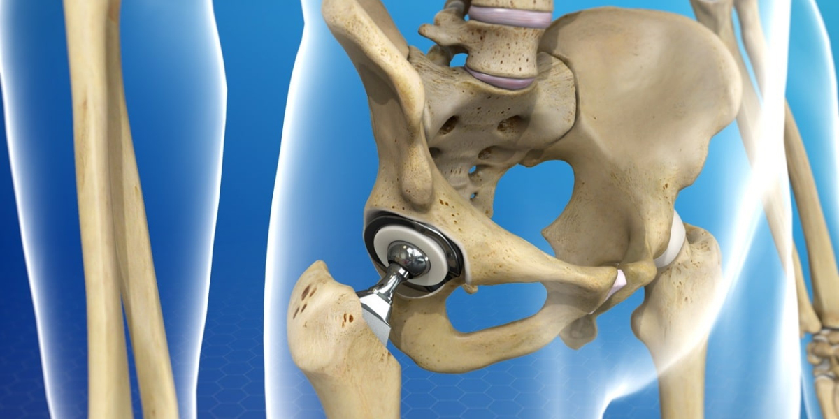 Endoprosthesis Market is Estimated To Witness High Growth