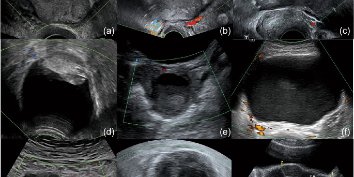 Ovarian Clear Cell Carcinoma Market Size, Epidemiology, Analysis & Trends 2023-2033