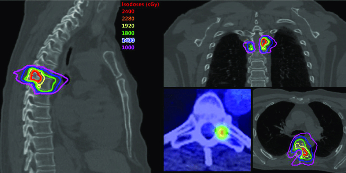 Stereotactic Spine Radiosurgery