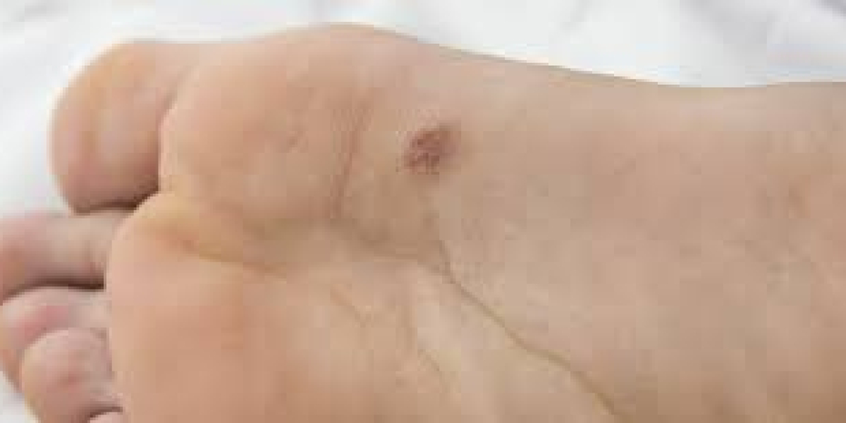 2023, Acral Lentiginous Melanoma Market Research Report Analysis by 2033