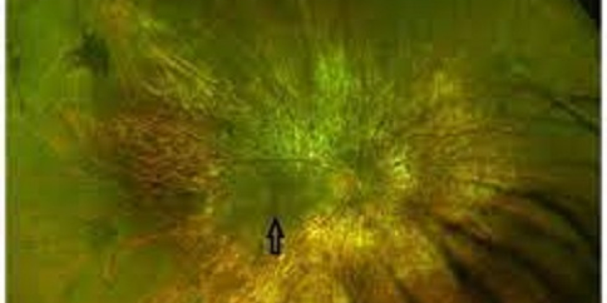 Choroideremia Market Epidemiology, Research Report, Analysis & Trends 2023-2033