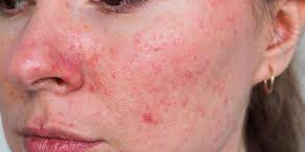 Papulopustular Rosacea Market Size, Epidemiology, Analysis & Trends 2023-2033