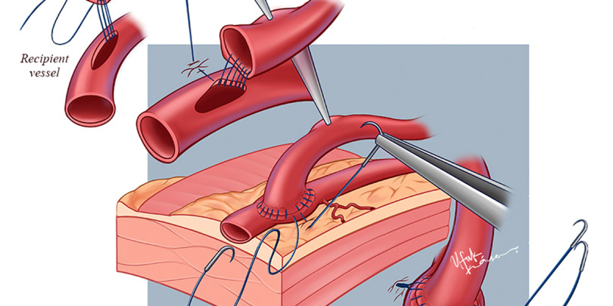 Global Anastomosis Devices Market Is Estimated To Witness High Growth Owing To Increasing Prevalence of Cardiovascular D