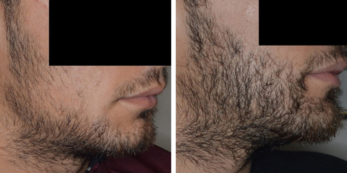 Do Facial Hair Transplants Really Work?