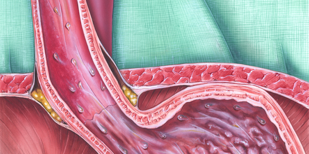 Gastroesophageal Junction Adenocarcinoma Market Analysis Report 2023 Along with Statistics, Forecasts till 2033