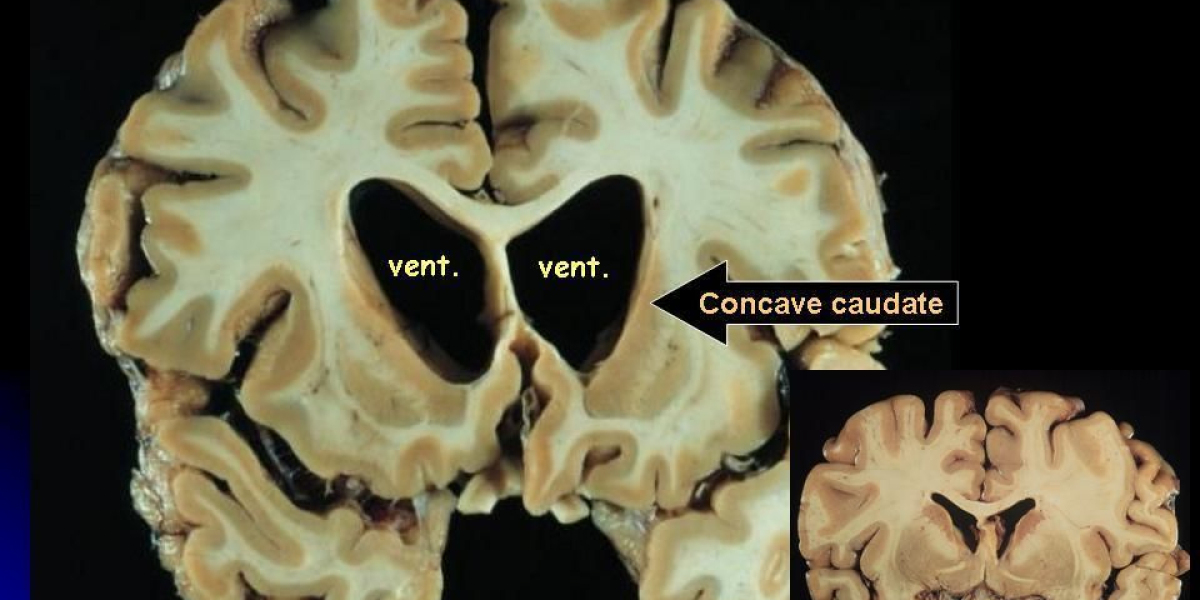 Navigating the Landscape of Huntington's Disease: Expert Insights