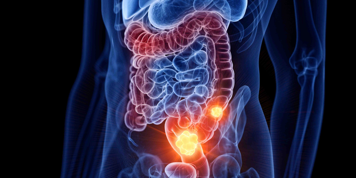 Elevate Your Strategy: Colorectal Cancer Market Entry Unraveled
