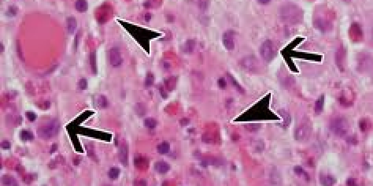 Langerhans Cell Histiocytosis Market Size, Epidemiology, Analysis & Trends 2023-2033