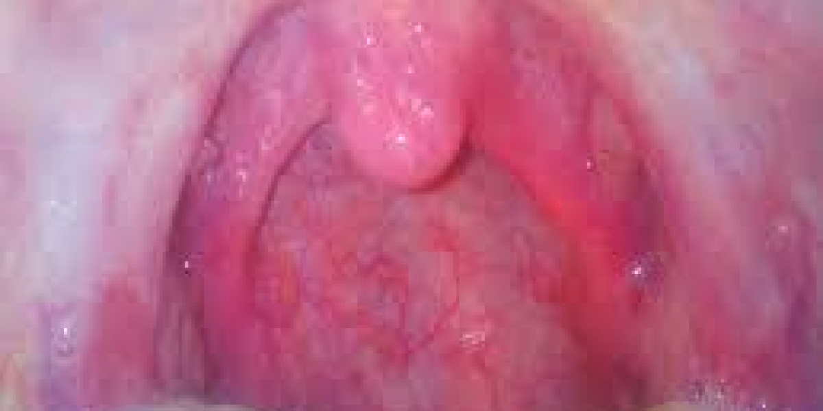 Pharyngitis Market Analysis Report 2023 Along with Statistics, Forecasts till 2033